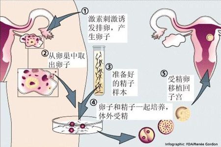 安孕冻胚移植专科